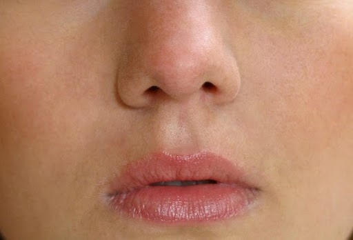 The rest of the pimples were removed