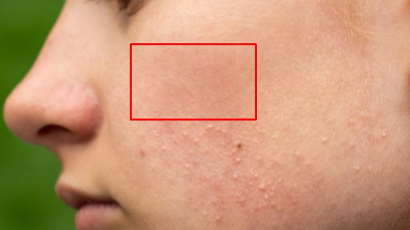 Remove Imperfections