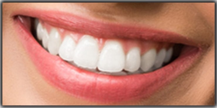 brightening the teeth